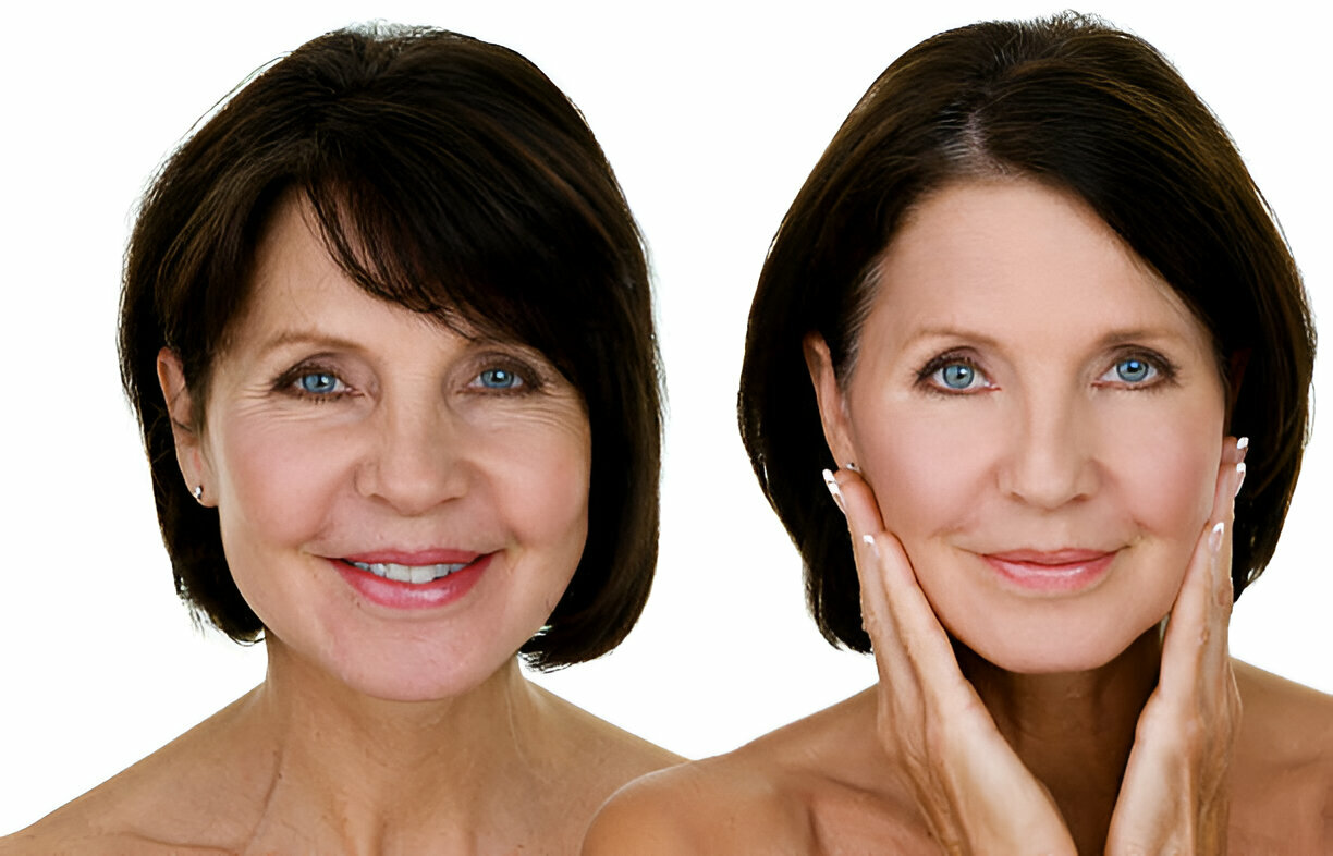 Wrinkles Treatment In Panchkula